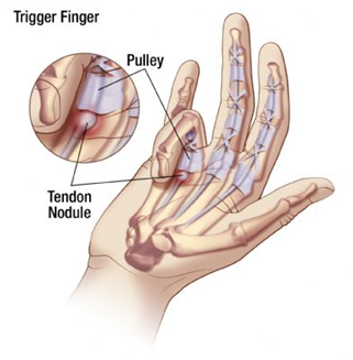 Trigger Finger  Orthopedic Specialists in Greater Grand Rapids, MI